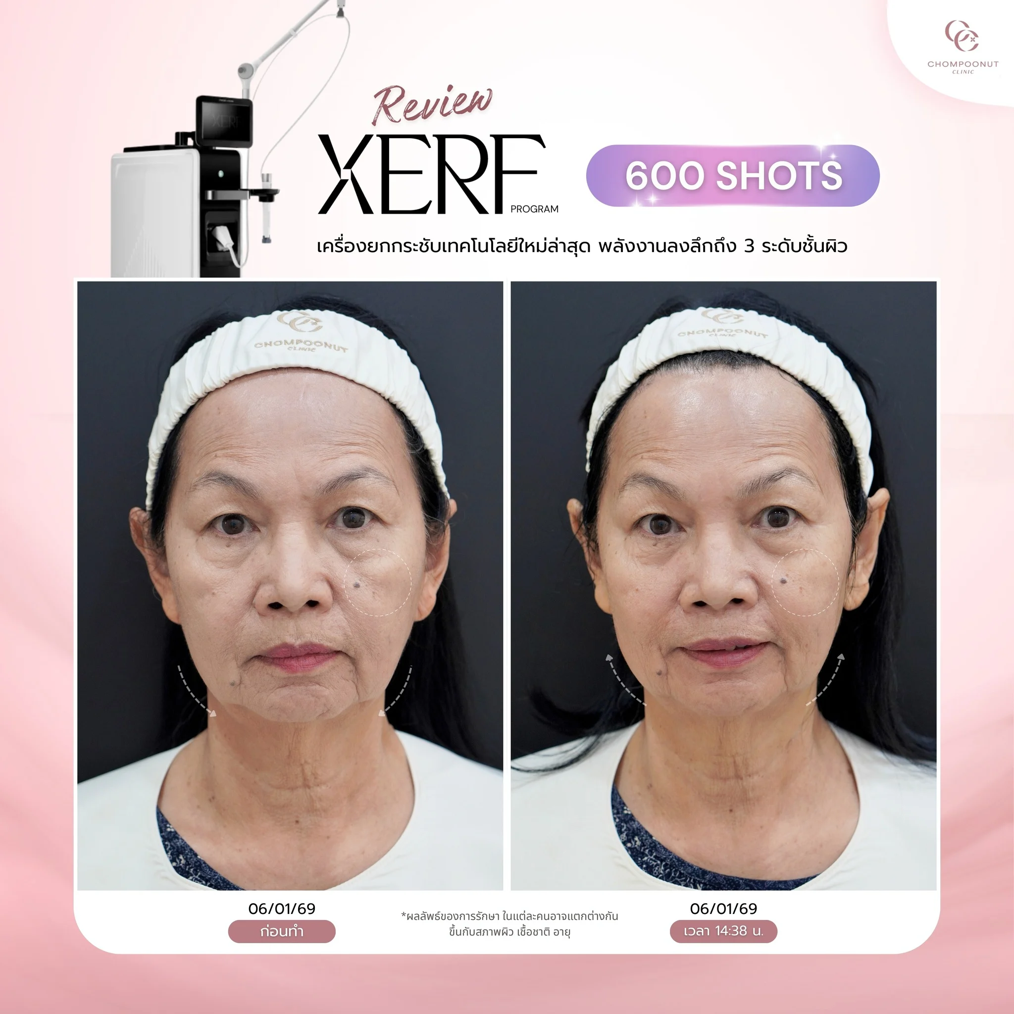 นวัตกรรม XERF ฟื้นฟูโครงสร้างผิวหน้าจากภายในที่ Chompoonut Clinic