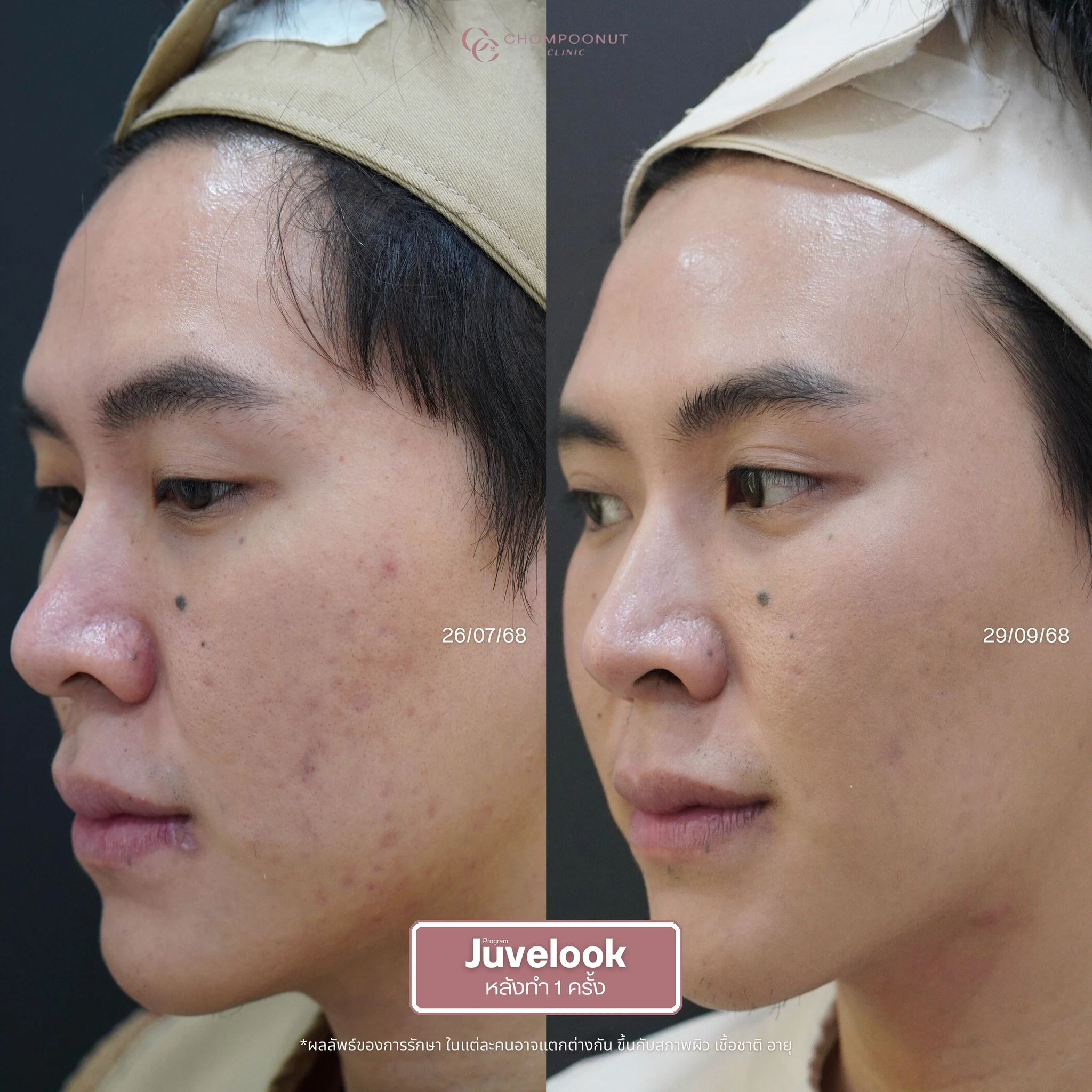 รีวิวที่จริงใจ โปรแกรม Juvelook ทำหน้า นครปฐม