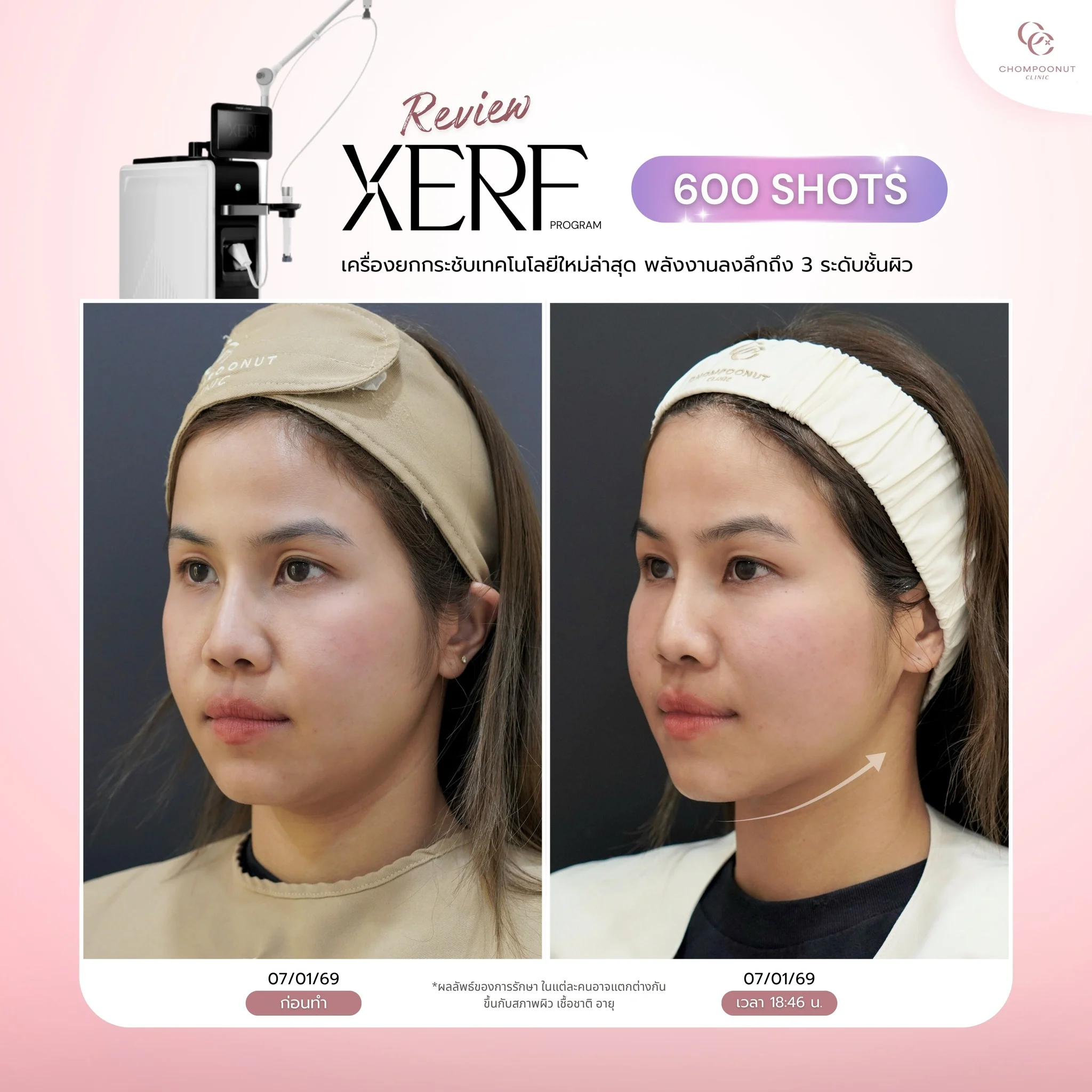 โปรแกรม XERF ช่วยให้ผิวหน้าแน่นเฟิร์ม เห็นผลชัดเจนหลังทำ