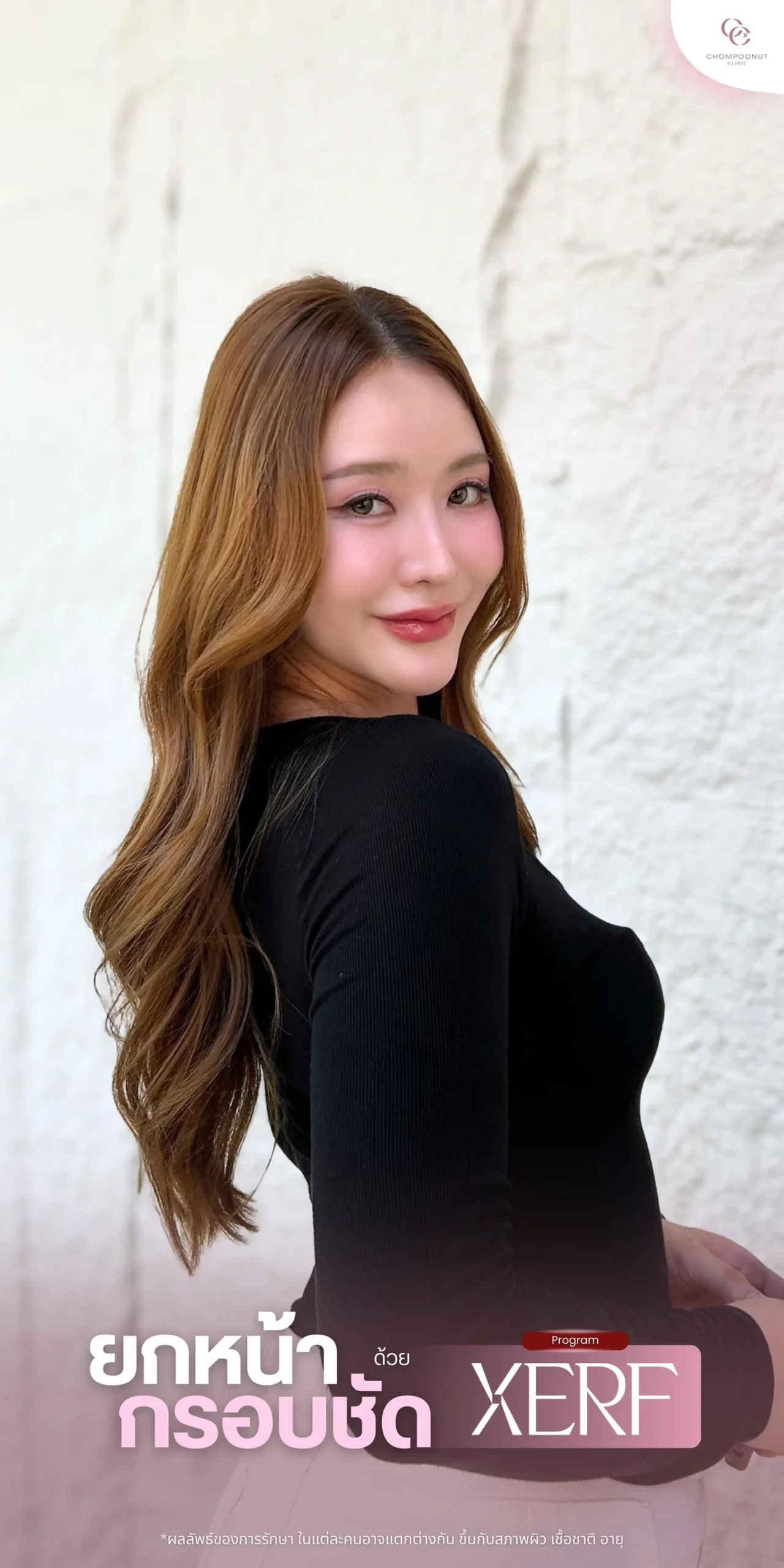ผลลัพธ์การยกกระชับผิวหน้าด้วยโปรแกรม XERF ที่ Chompoonut Clinic