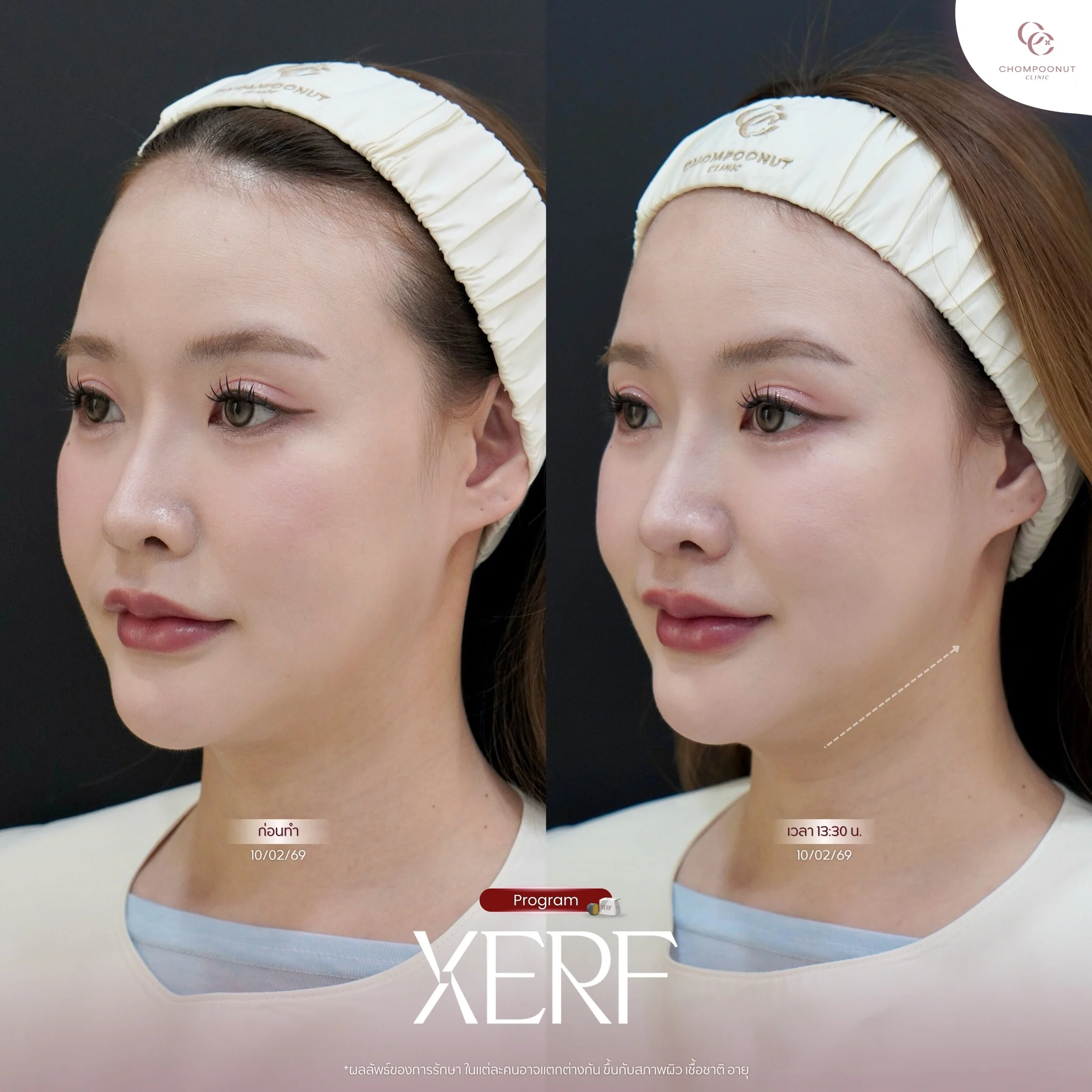 ผิวหน้ากระชับ เรียบเนียน หลังทำ XERF โดยแพทย์เฉพาะทาง นครปฐม