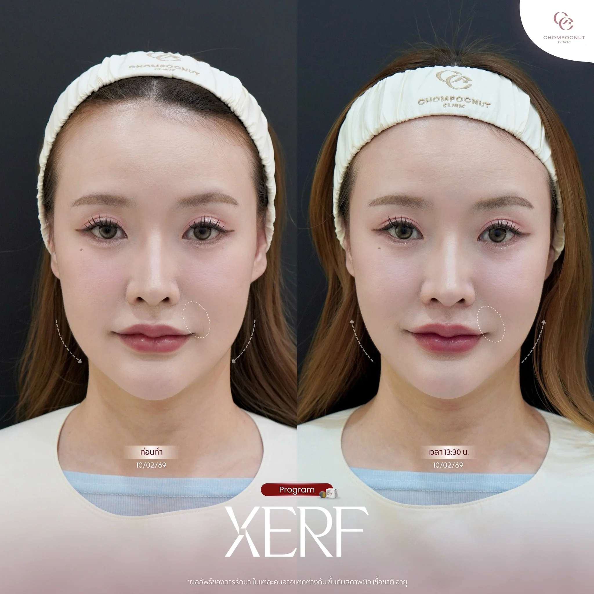เปรียบเทียบก่อน-หลัง ทำโปรแกรม XERF แก้ปัญหากระเปาะแก้มหย่อนคล้อย