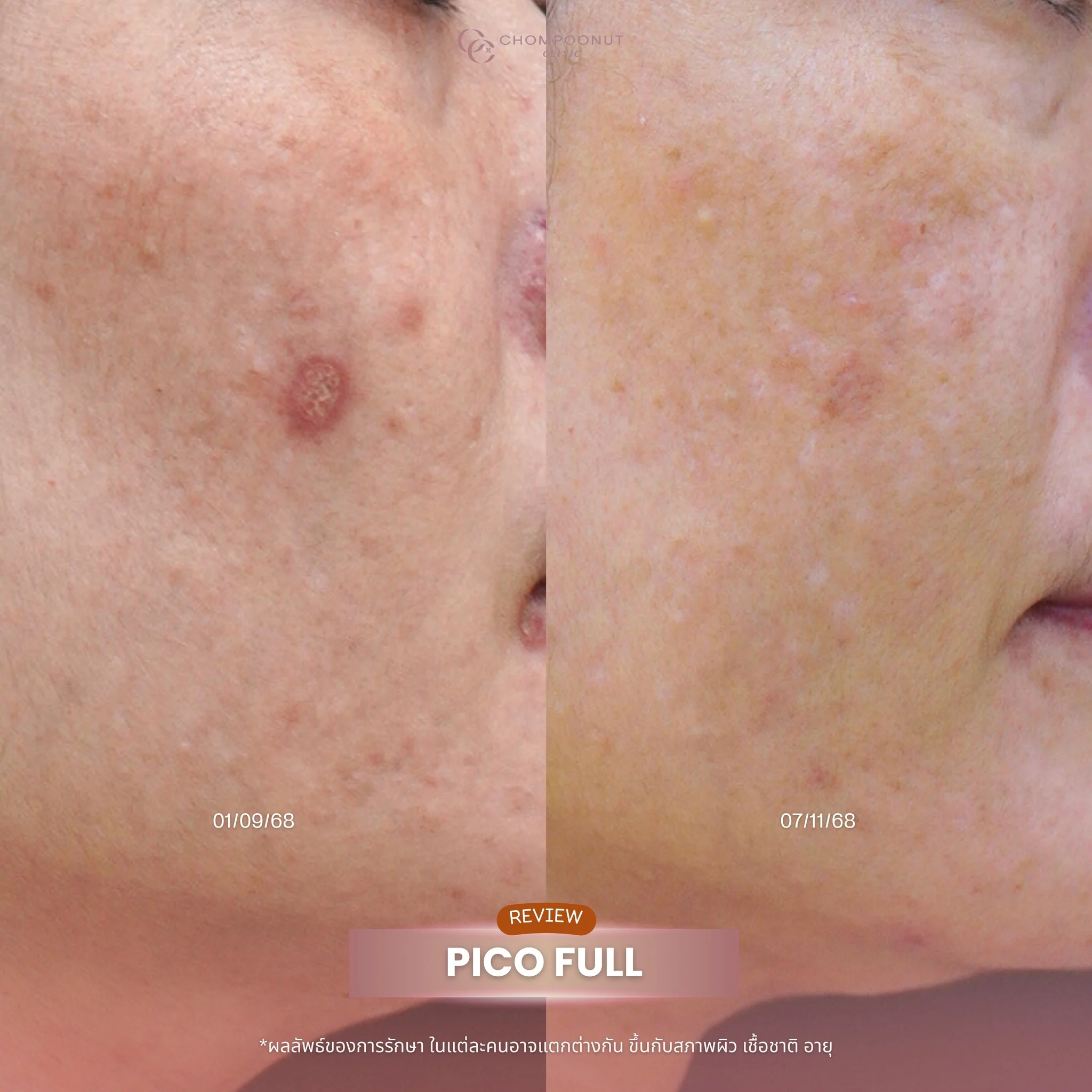 ผิวหน้าเรียบเนียนหลังรับบริการ Pico Majesty