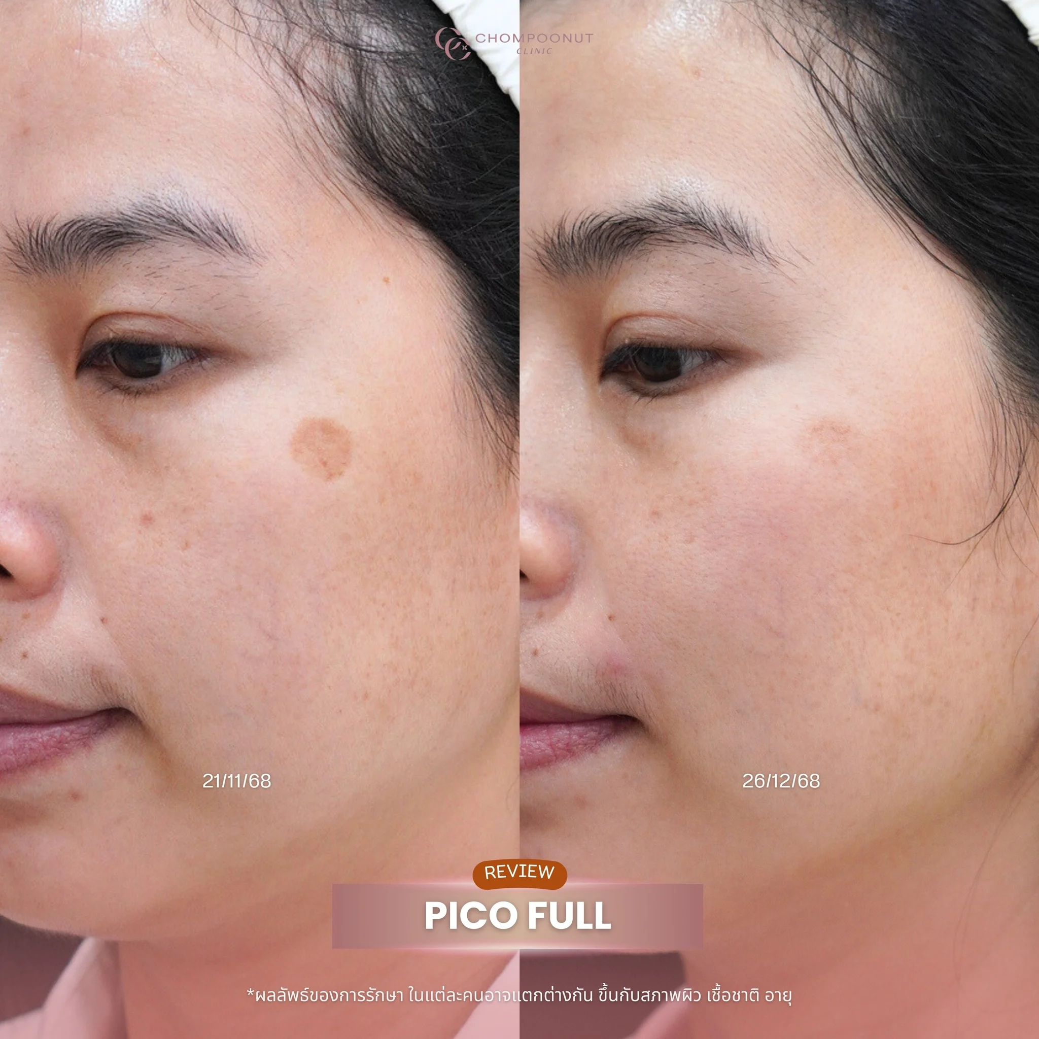 รักษาจุดด่างดำด้วยเลเซอร์: รีวิวผลลัพธ์