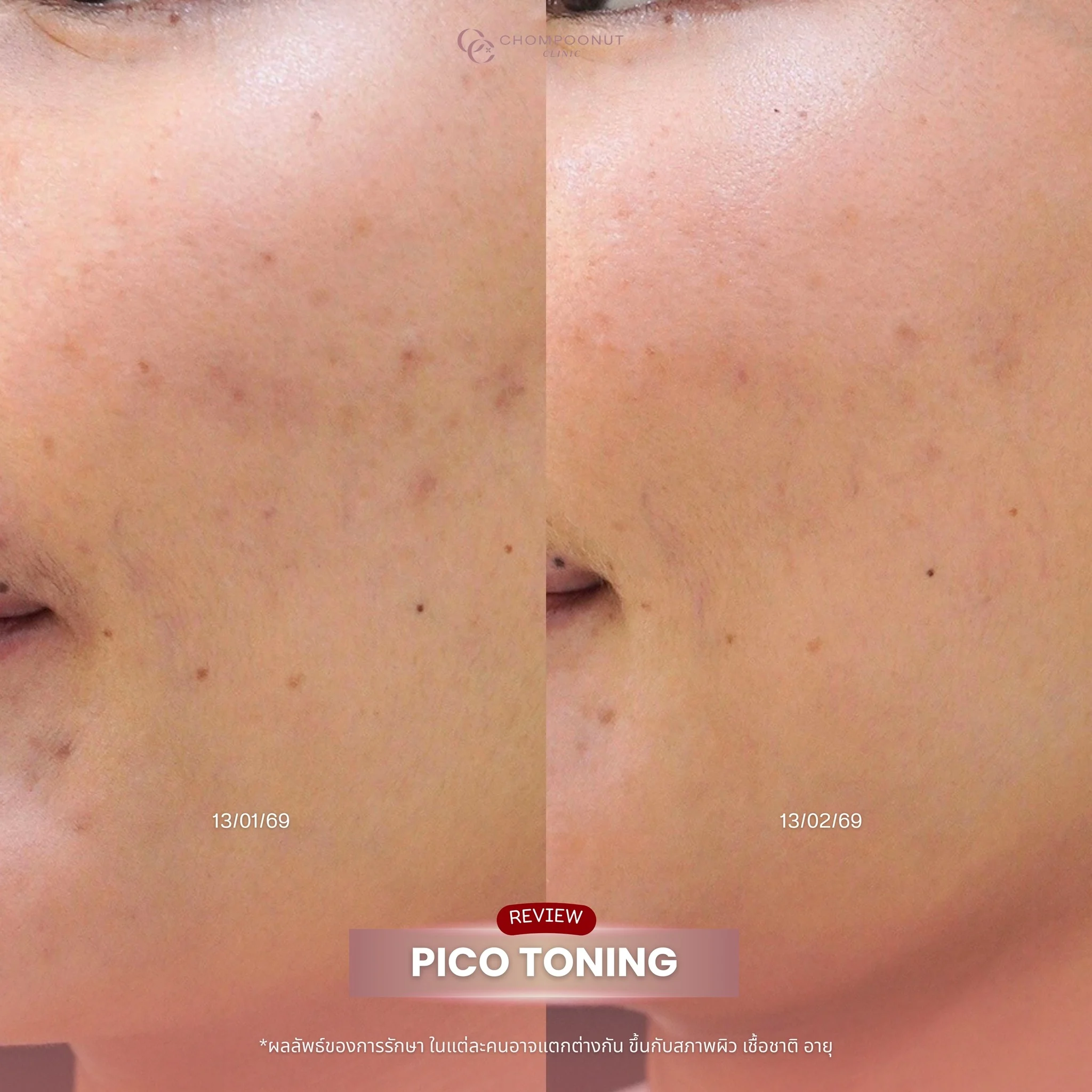 ผิวใส รูขุมขนกระชับ หลังทำ Pico Majesty Laser