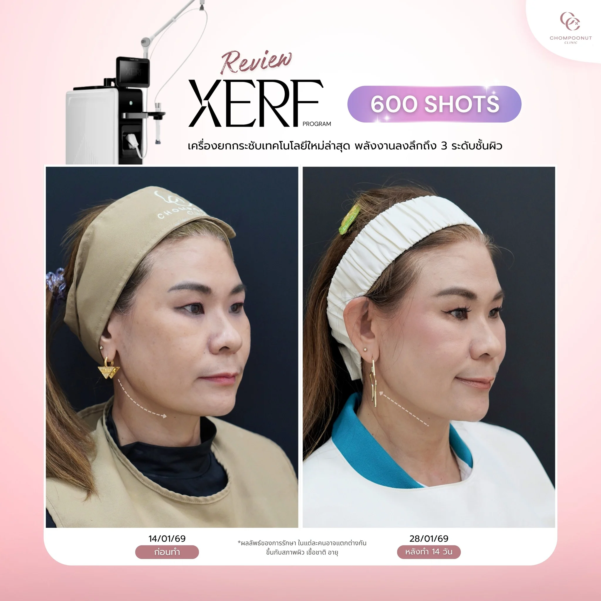 รีวิวการเก็บกระเปาะแก้มและยกกระชับผิวหน้าด้วย XERF