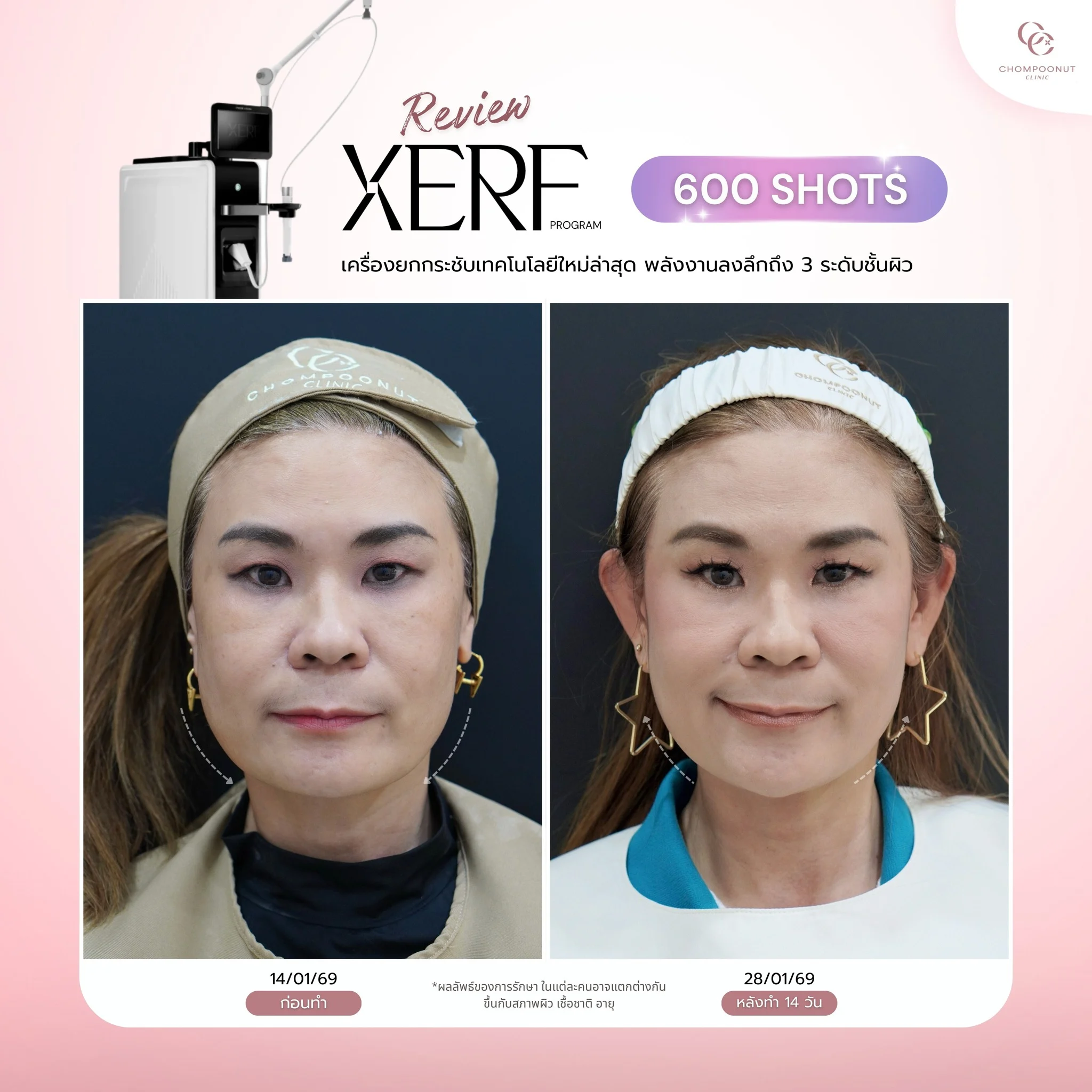 ผลลัพธ์การกระตุ้นคอลลาเจนด้วยโปรแกรม XERF ที่ Chompoonut Clinic