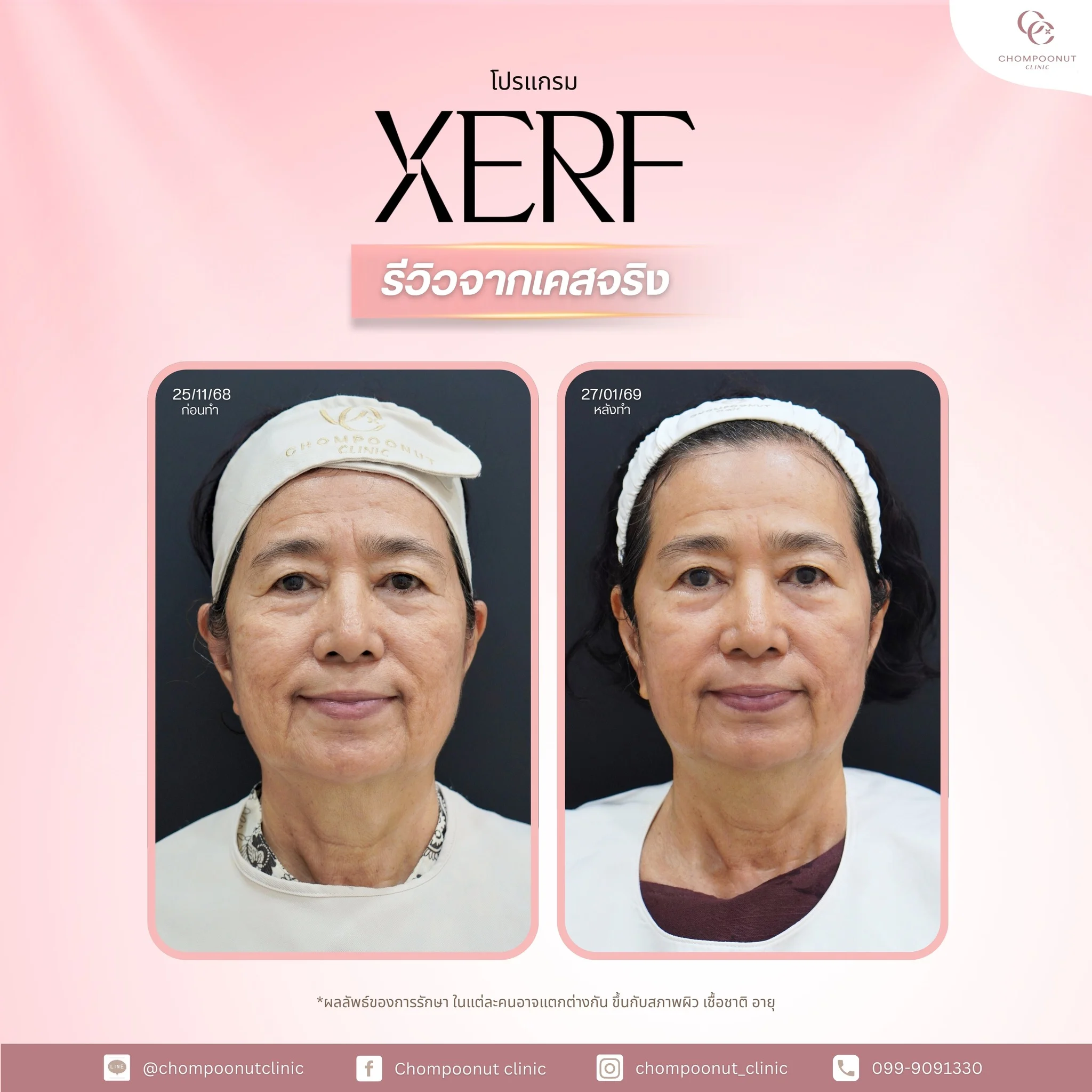 หลังทำโปรแกรม XERF ใบหน้าดูเรียวสวยเป็นธรรมชาติ ไม่ต้องผ่าตัด