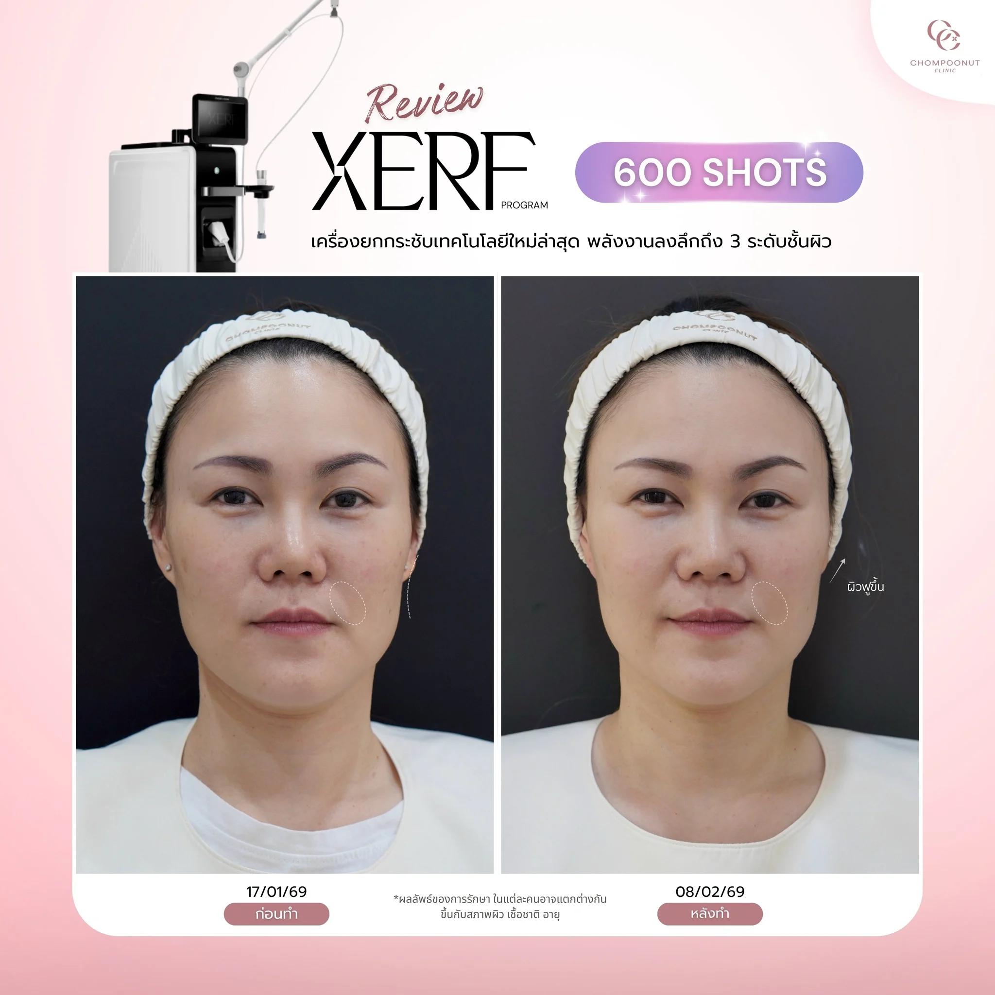 รีวิว XERF ยกกระชับกรอบหน้าให้คมชัด เห็นผลทันทีที่คลินิกหมอชมพูนุท