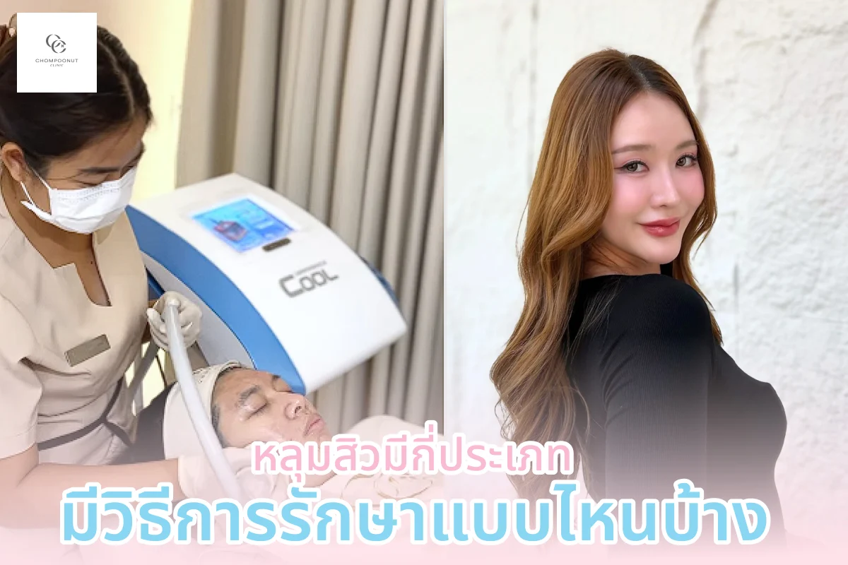 หลุมสิวมีกี่ประเภท มีวิธีการรักษาแบบไหนบ้าง