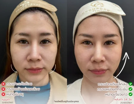 รีวิวที่จริงใจ โปรแกรม Meso Fat ทำหน้า นครปฐม
