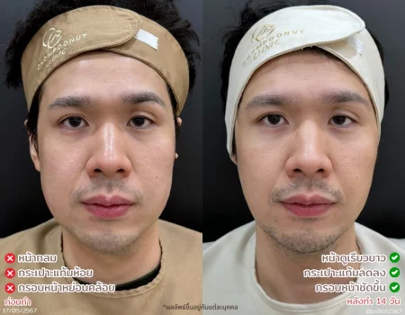 รีวิวที่จริงใจ โปรแกรม Meso Fat ทำหน้า นครปฐม