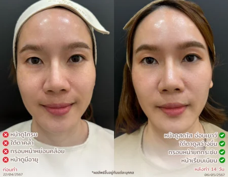 รีวิวที่จริงใจ โปรแกรม Meso Fat ทำหน้า นครปฐม