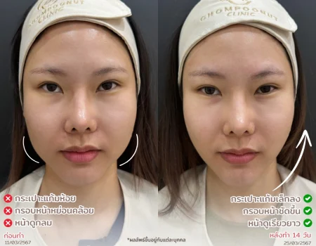 รีวิวที่จริงใจ โปรแกรม Meso Fat ทำหน้า นครปฐม