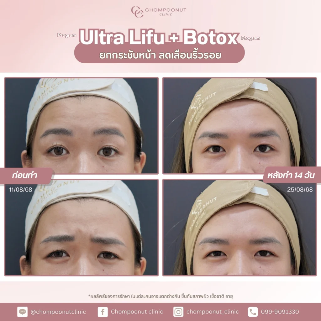 รีวิวโปรแกรม botox โปรแกรม ทำหน้า นครปฐม ที่ chompoonut Clinic