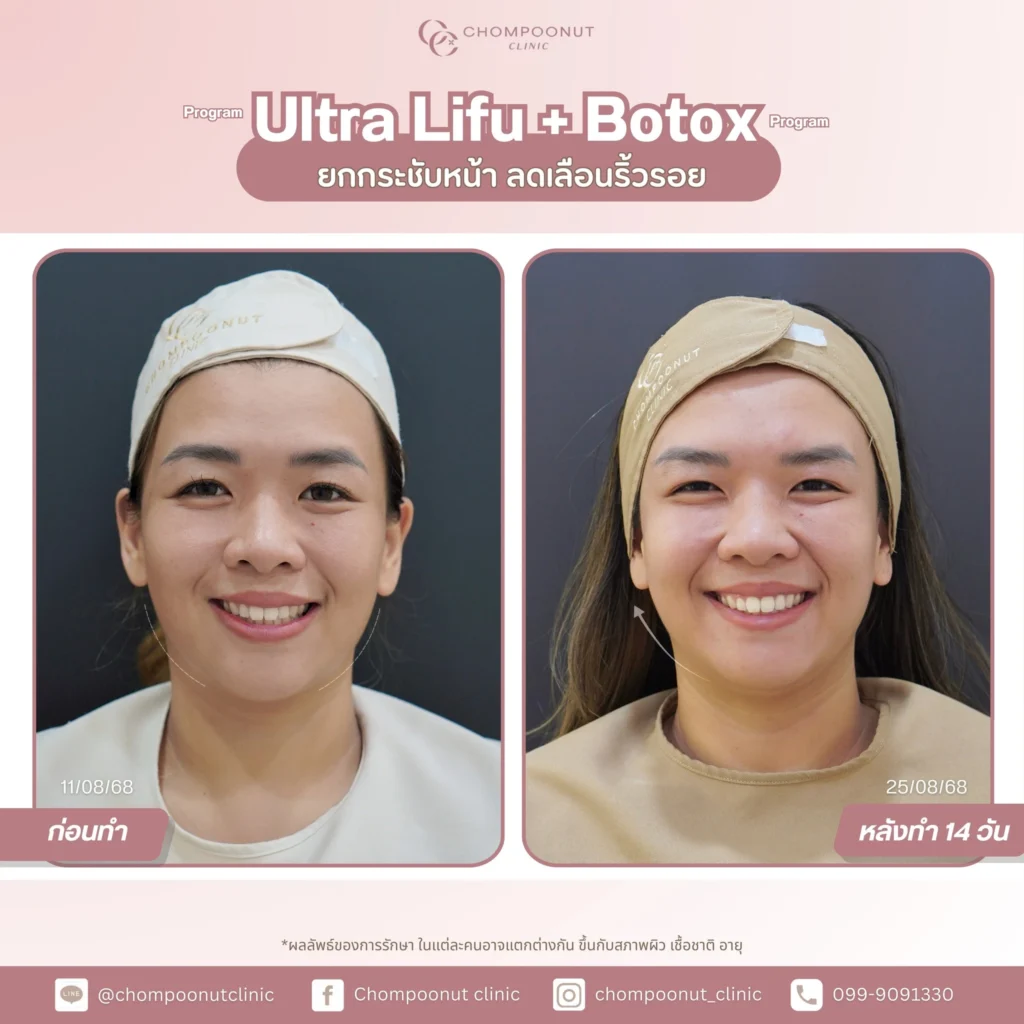 รีวิวโปรแกรม botox โปรแกรม ทำหน้า นครปฐม ที่ chompoonut Clinic