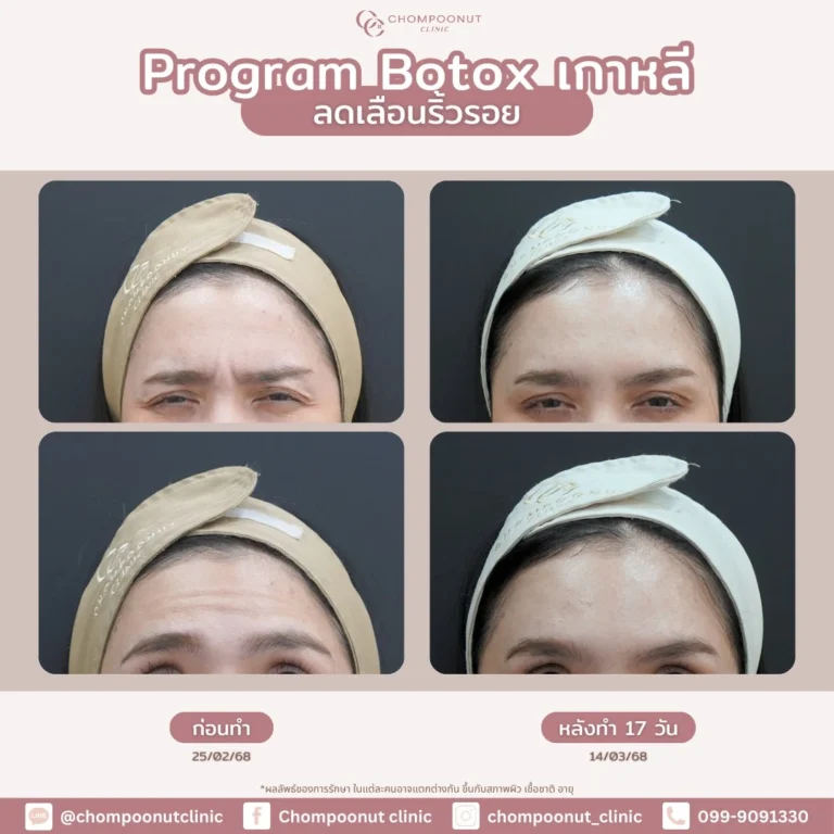 รีวิวโปรแกรม Botox ที่ชมพูนุชคลีนิก คลีนิกความงาม นครปฐม