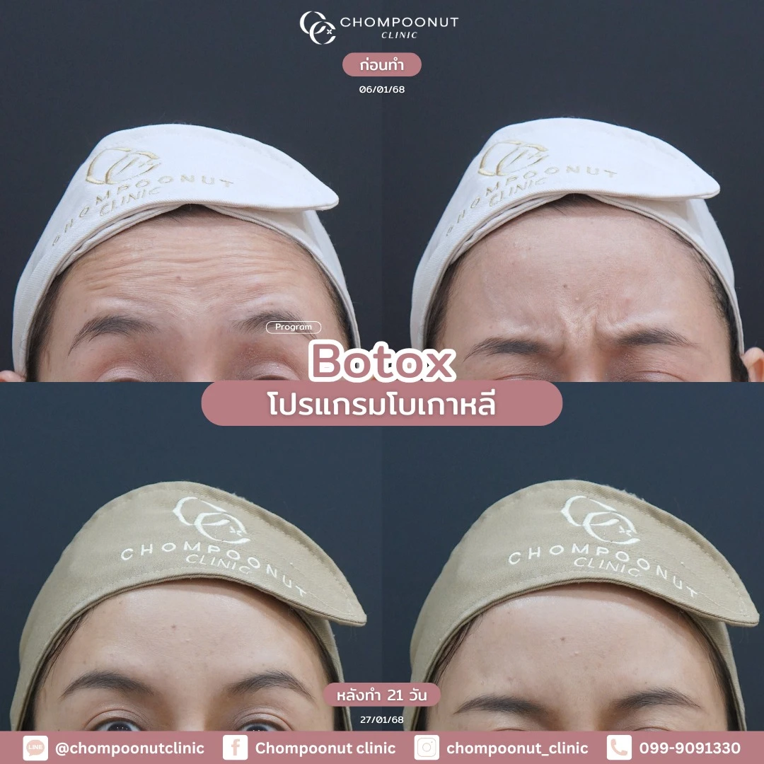 รีวิวโปรแกรม Botox ที่ชมพูนุชคลีนิก คลีนิกความงาม นครปฐม