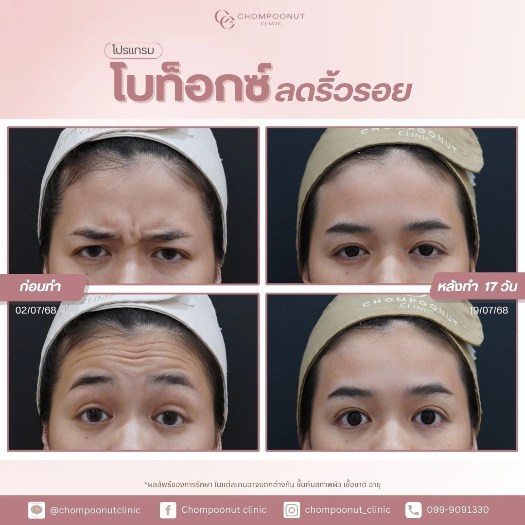 รีวิวโปรแกรม Botox ที่ชมพูนุชคลีนิก คลีนิกความงาม นครปฐม