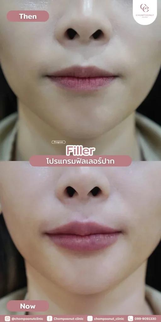 Program Filler คืออะไร เหมาะกับใครบ้าง ?