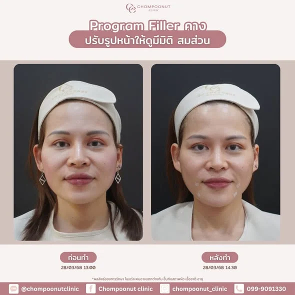รีวิว โปรแกรมฟิลเลอร์คาง