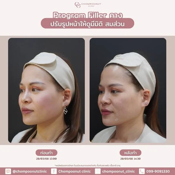 รีวิว โปรแกรมฟิลเลอร์คาง