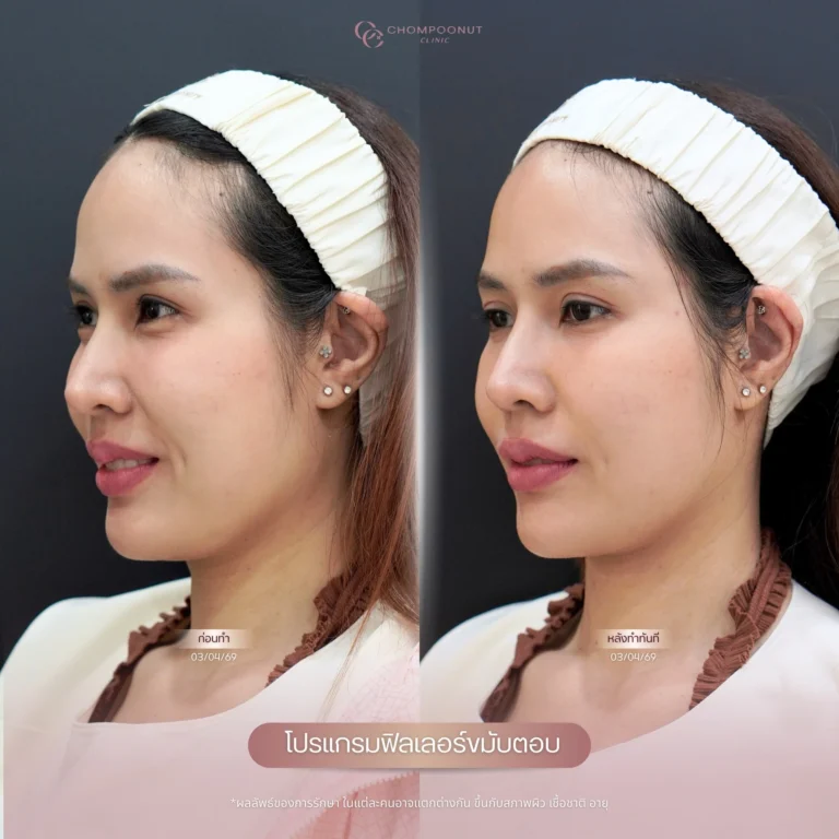 รีวิว โปรแกรมฟิลเลอร์คาง
