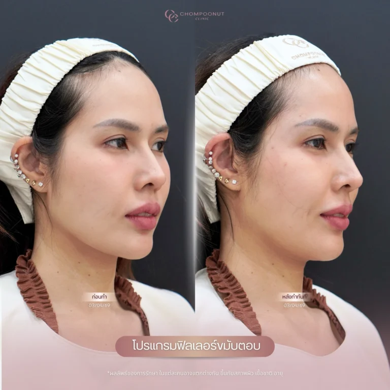 รีวิว โปรแกรมฟิลเลอร์คาง