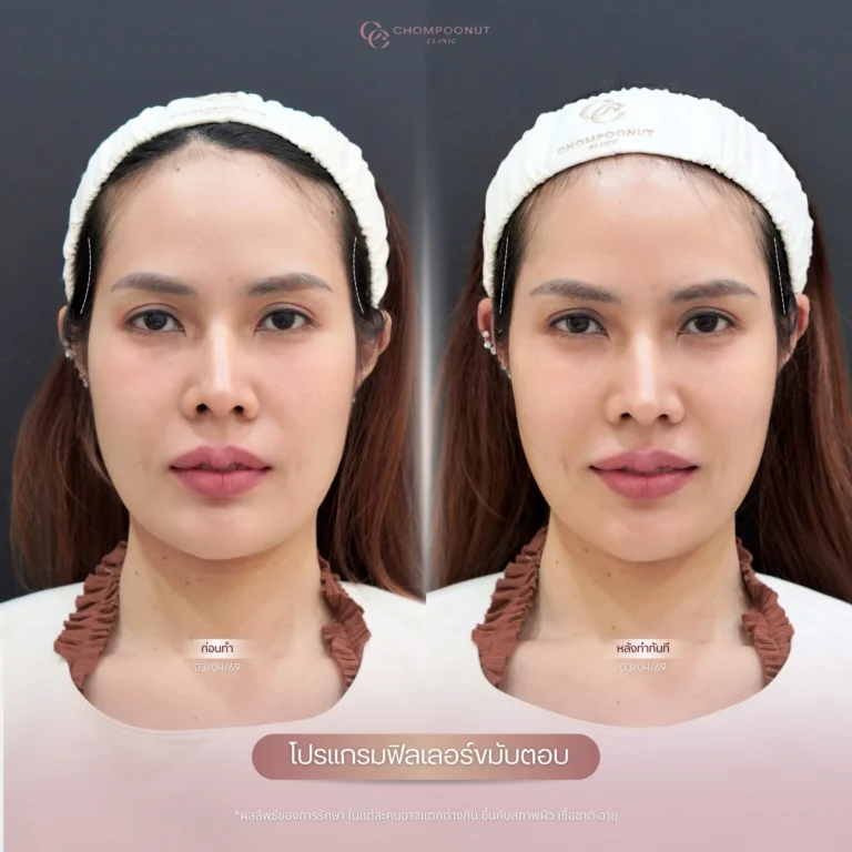 รีวิว โปรแกรม Filler ​