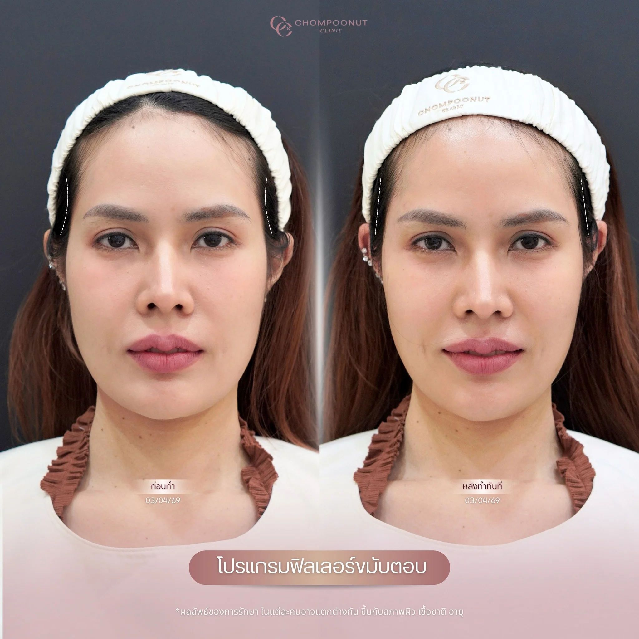 รีวิว โปรแกรมฟิลเลอร์คาง