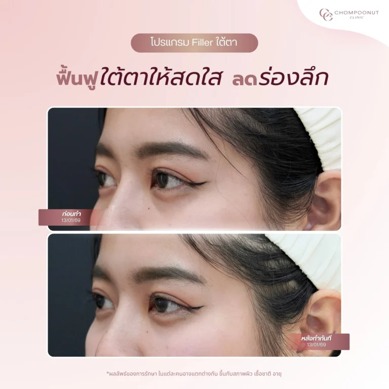 โปรแกรมฟิลเลอร์ใต้ตา
