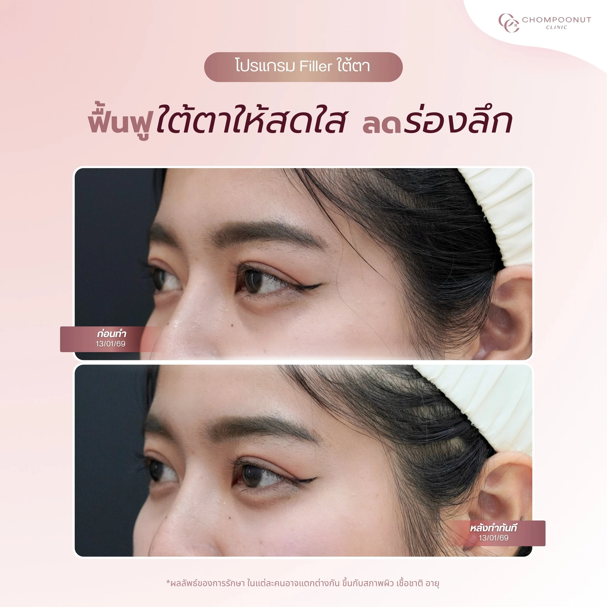 โปรแกรมฟิลเลอร์ใต้ตา
