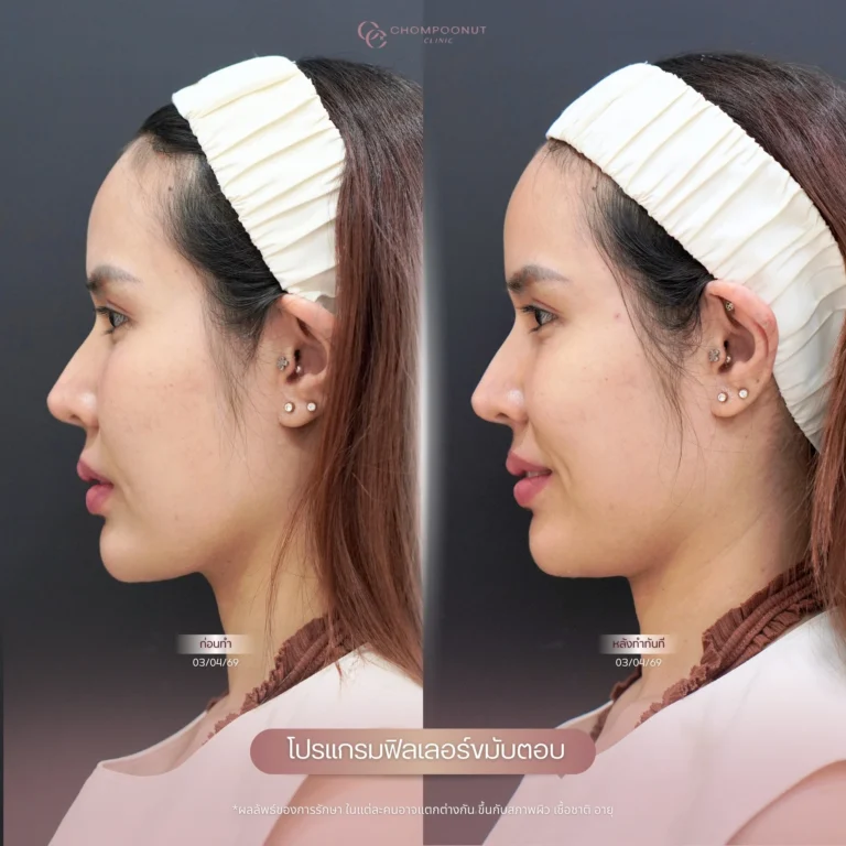 รีวิว โปรแกรมฟิลเลอร์คาง