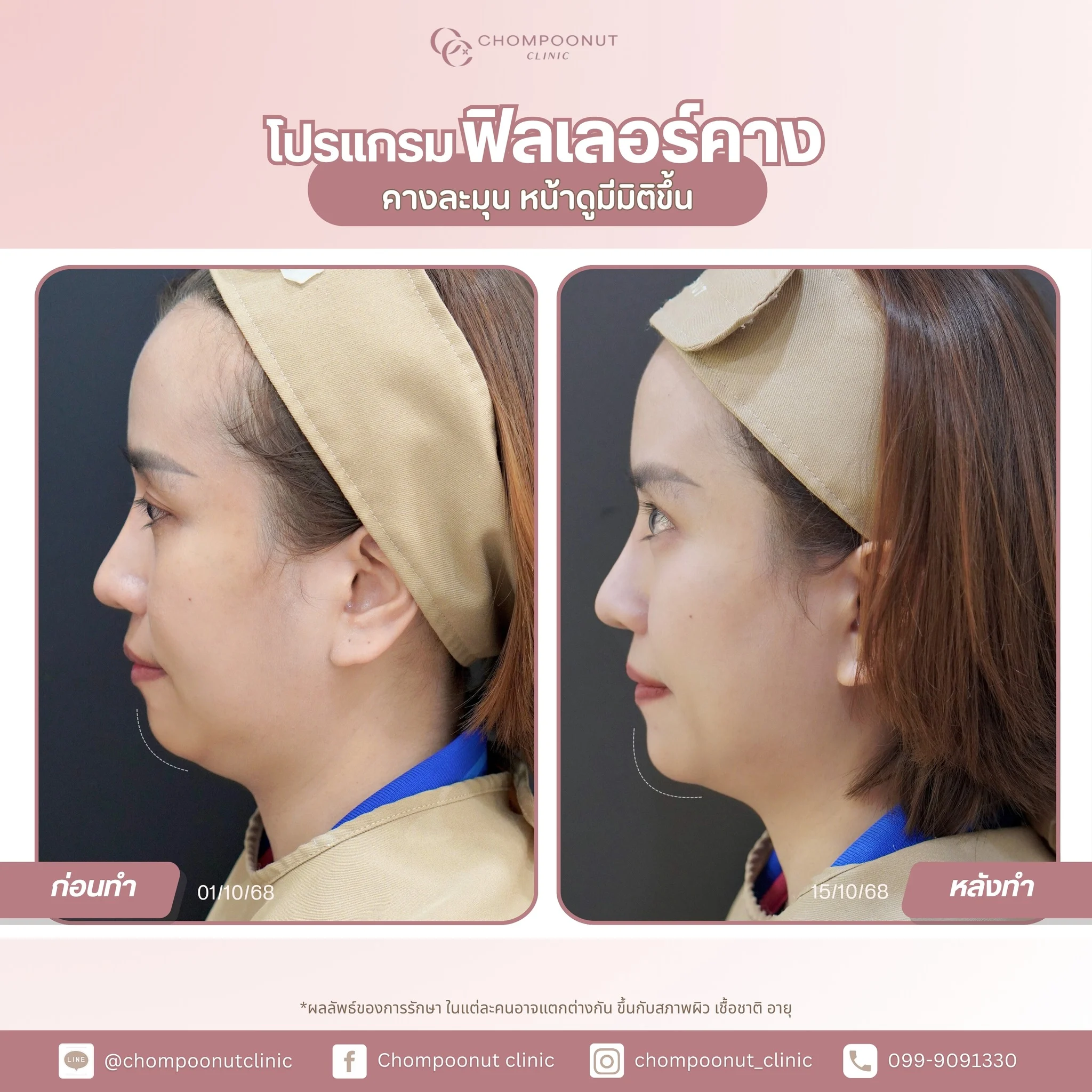 รีวิว โปรแกรมฟิลเลอร์คาง