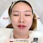 รีวิว Ulthera Prime ก่อนหลัง