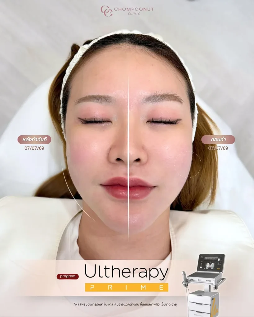 รีวิว Ulthera Prime ก่อนหลัง