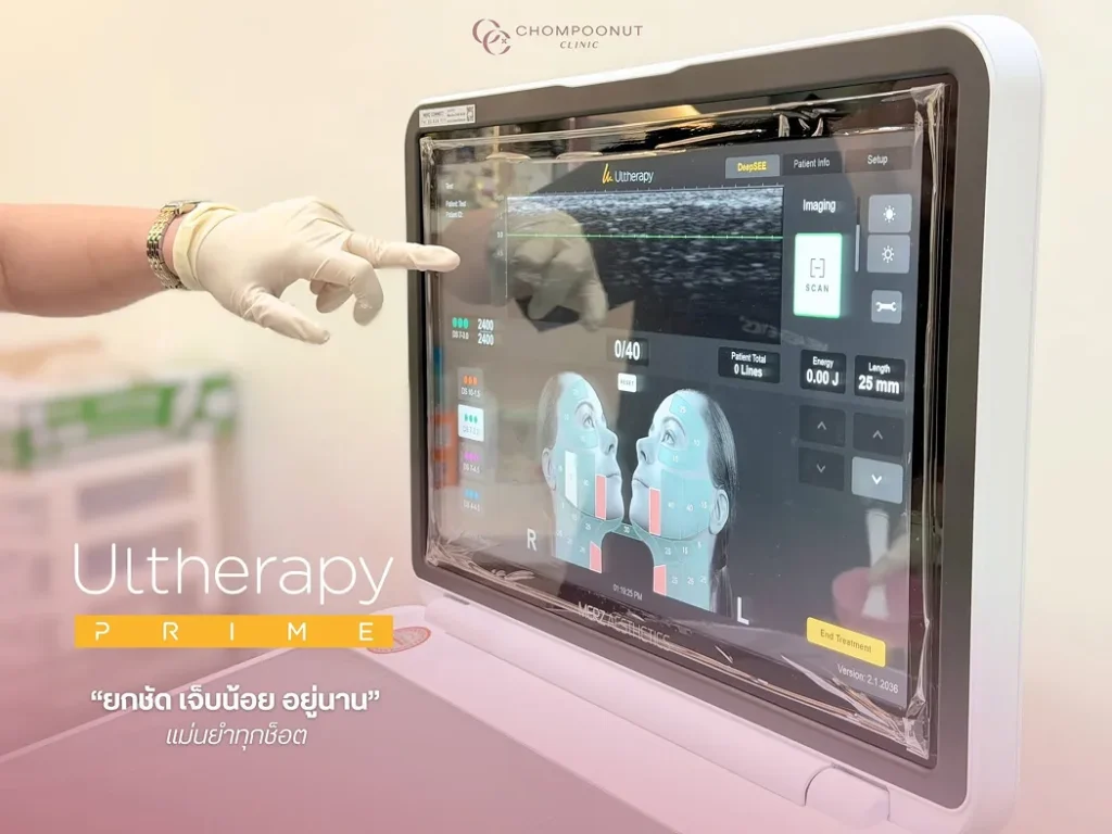 รีวิว Ulthera Prime เจ็บไหม