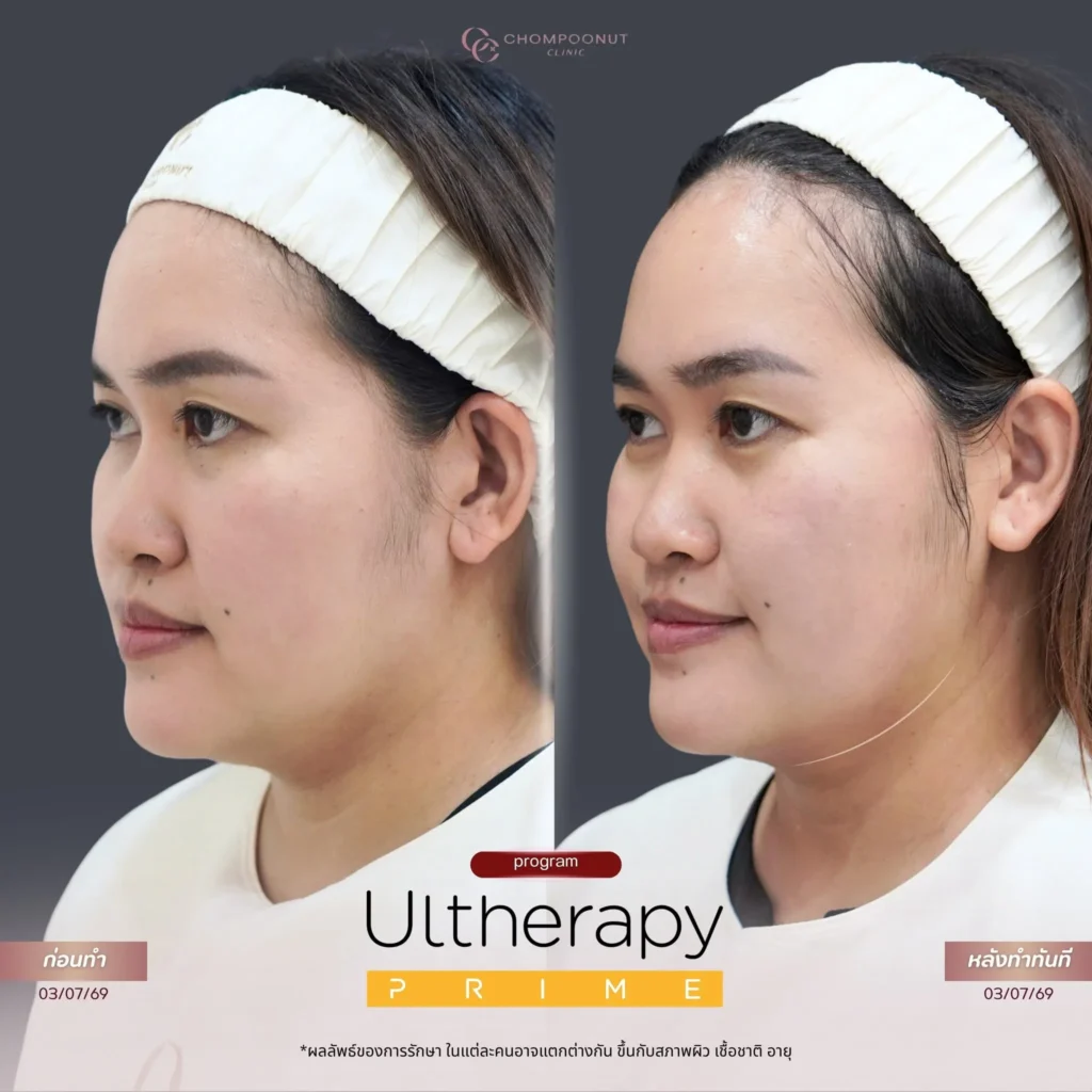 รีวิว Ultherapy Prime