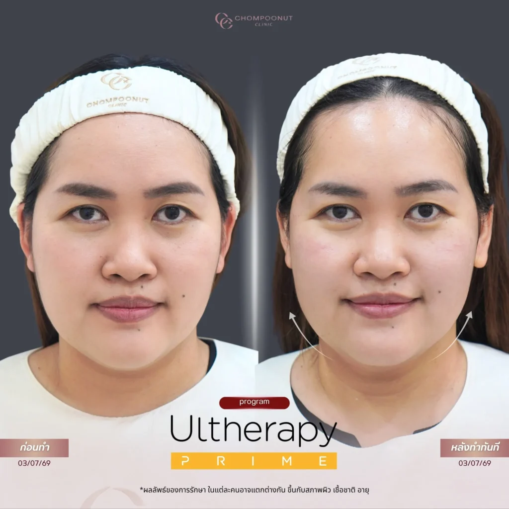 รีวิว Ulthera