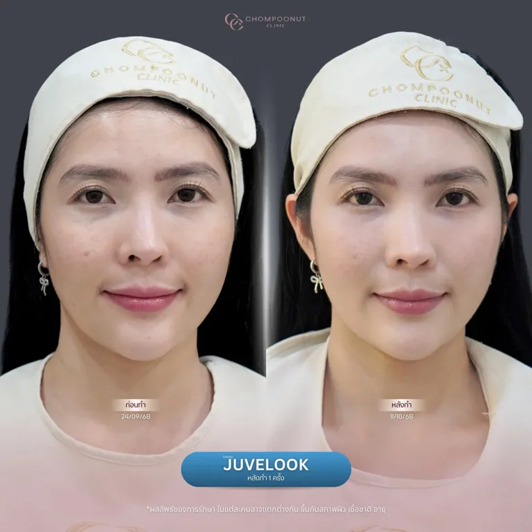 ผลลัพธ์หลังฉีด Juvelook นครปฐม ผิวฉ่ำวาว อ่อนเยาว์ ครบ 2 สัปดาห์