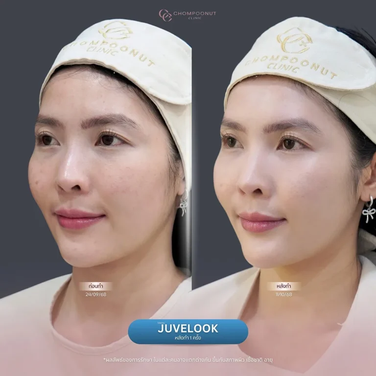 รีวิว Juvelook นครปฐม ปรับคุณภาพผิว โดยแพทย์เฉพาะทาง ชมพูนุทคลินิก